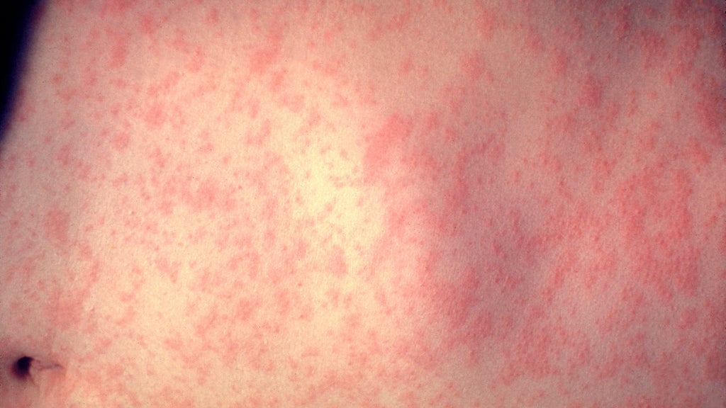 25 cases of measles identified in central, southeastern Minnesota, MDH says — WCCO / CBS Minnesota, Venice Health news