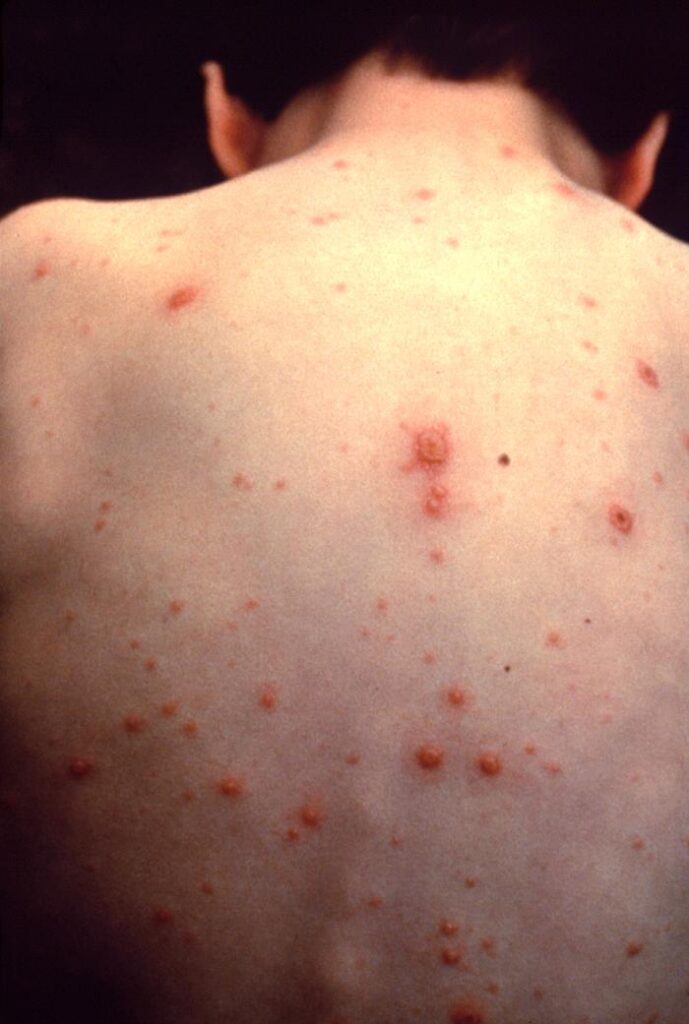 As state considers vaccine changes, new online tool examines sickness, death, cost impacts — Florida Phoenix, Venice Health news