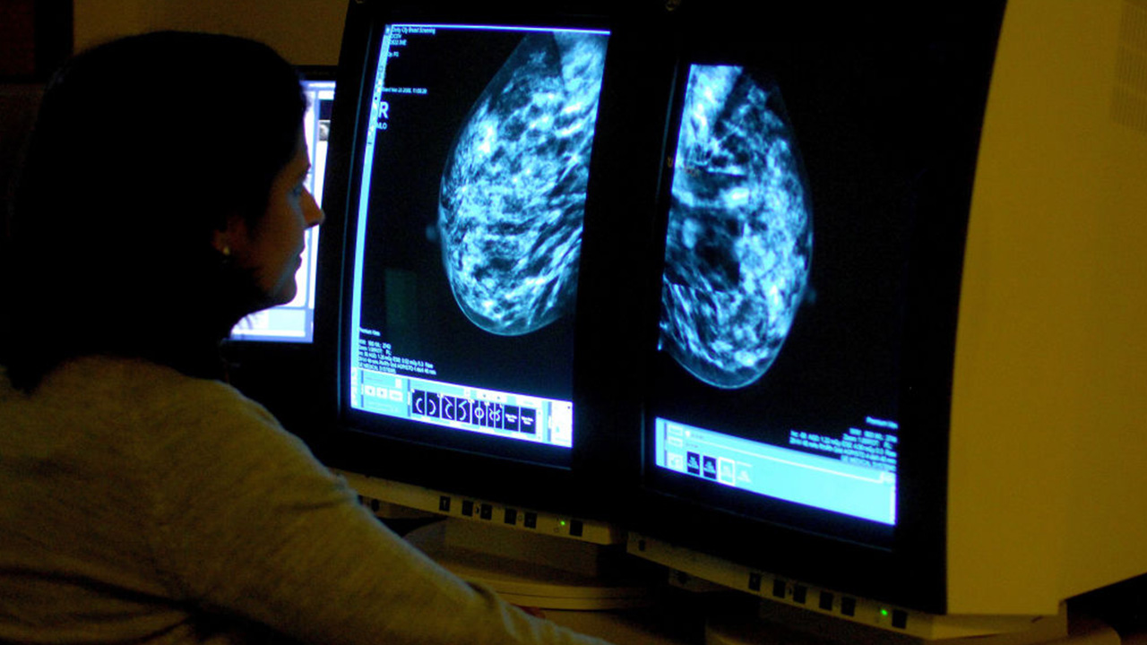 Targeted drug shrinks tumors in 3 out of 4 patients with advanced breast cancer — FOX 13 Tampa Bay News